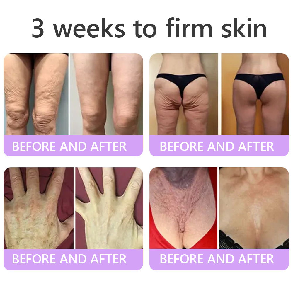 🦩Suiiao® Multi-Peptide Body Massager & Cream — Anti-aging, moisturizing, firming and lifting, skin barrier repair, skin tone evening, acne-prone skin care, blemish, wart, and mole reduction, as well as psoriasis symptom relief