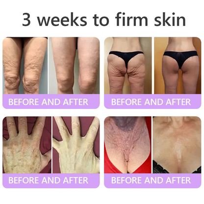 🦩Suiiao® Multi-Peptide Body Massager & Cream — Anti-aging, moisturizing, firming and lifting, skin barrier repair, skin tone evening, acne-prone skin care, blemish, wart, and mole reduction, as well as psoriasis symptom relief