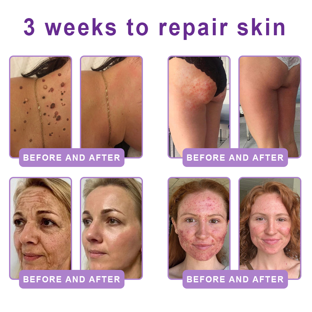 🦩Suiiao® Multi-Peptide Body Massager & Cream — Anti-aging, moisturizing, firming and lifting, skin barrier repair, skin tone evening, acne-prone skin care, blemish, wart, and mole reduction, as well as psoriasis symptom relief