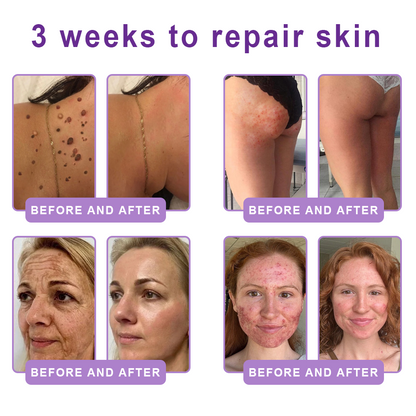 🦩Suiiao® Multi-Peptide Body Massager & Cream — Anti-aging, moisturizing, firming and lifting, skin barrier repair, skin tone evening, acne-prone skin care, blemish, wart, and mole reduction, as well as psoriasis symptom relief