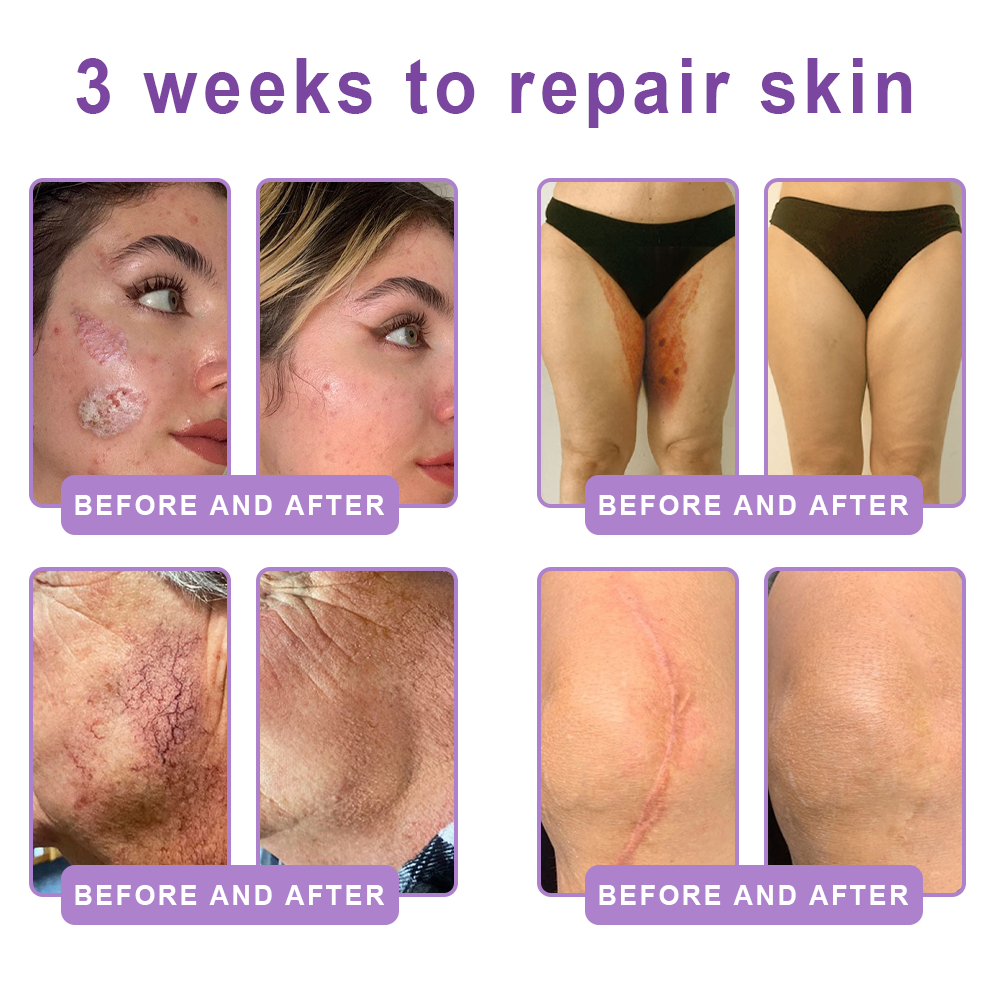 🦩Suiiao® Multi-Peptide Body Massager & Cream — Anti-aging, moisturizing, firming and lifting, skin barrier repair, skin tone evening, acne-prone skin care, blemish, wart, and mole reduction, as well as psoriasis symptom relief