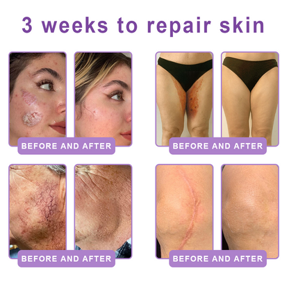 🦩Suiiao® Multi-Peptide Body Massager & Cream — Anti-aging, moisturizing, firming and lifting, skin barrier repair, skin tone evening, acne-prone skin care, blemish, wart, and mole reduction, as well as psoriasis symptom relief