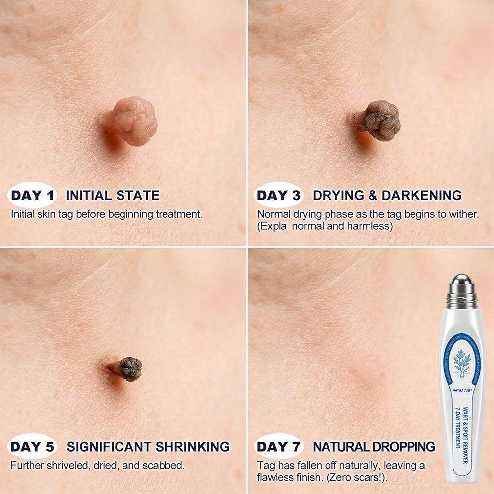 𝐎𝐟𝐟𝐢𝐜𝐢𝐚𝐥 𝐁𝐫𝐚𝐧𝐝 𝐒𝐭𝐨𝐫𝐞 |🖊️NATRAVOR® 7-Day Skin Tag & Blemish Remover𝐫 Rollerball Pen🖊️✨