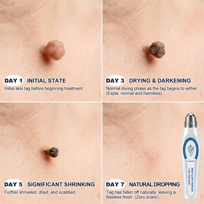 𝐎𝐟𝐟𝐢𝐜𝐢𝐚𝐥 𝐁𝐫𝐚𝐧𝐝 𝐒𝐭𝐨𝐫𝐞 |🖊️NATRAVOR® 7-Day Skin Tag & Blemish Remover𝐫 Rollerball Pen🖊️✨